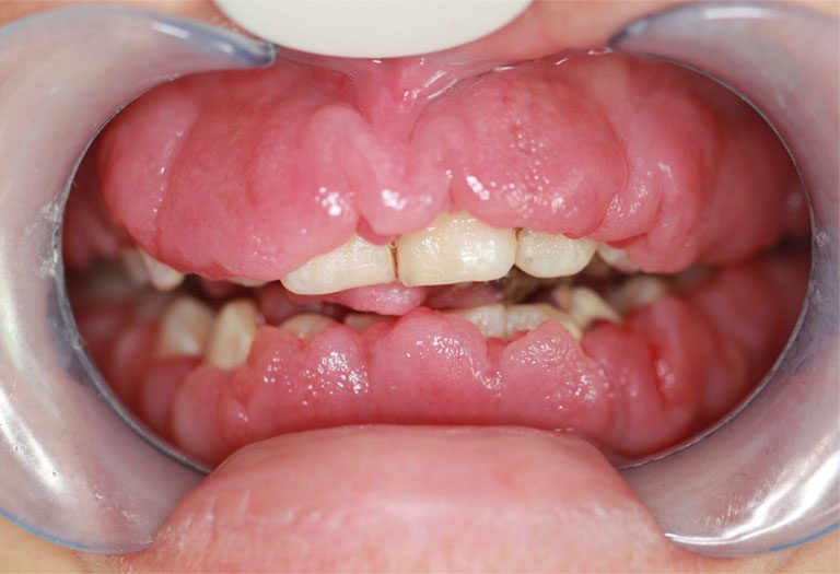 Viêm lợi phì đại là tình trạng lợi bị viêm nhiễm, mô nướu răng tăng sinh, phát triển quá mức