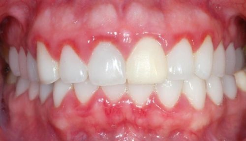 Viêm lợi sau khi bọc răng sứ không hiếm gặp, có thể do nhiều nguyên nhân gây ra