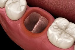 Có nhiều nguyên nhân gây ra tình trạng viêm lợi sau khi nhổ răng
