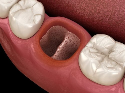 Có nhiều nguyên nhân gây ra tình trạng viêm lợi sau khi nhổ răng
