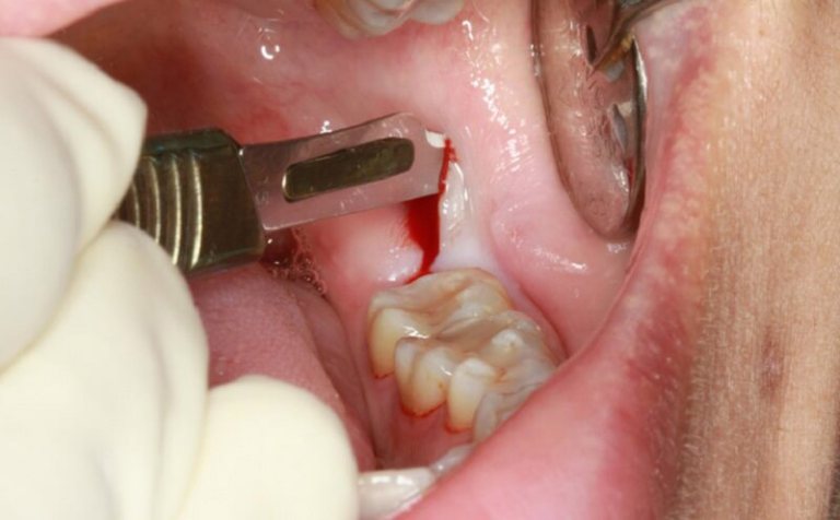 Viêm lợi trùm có mủ thường liên quan đến quá trình mọc của răng khôn