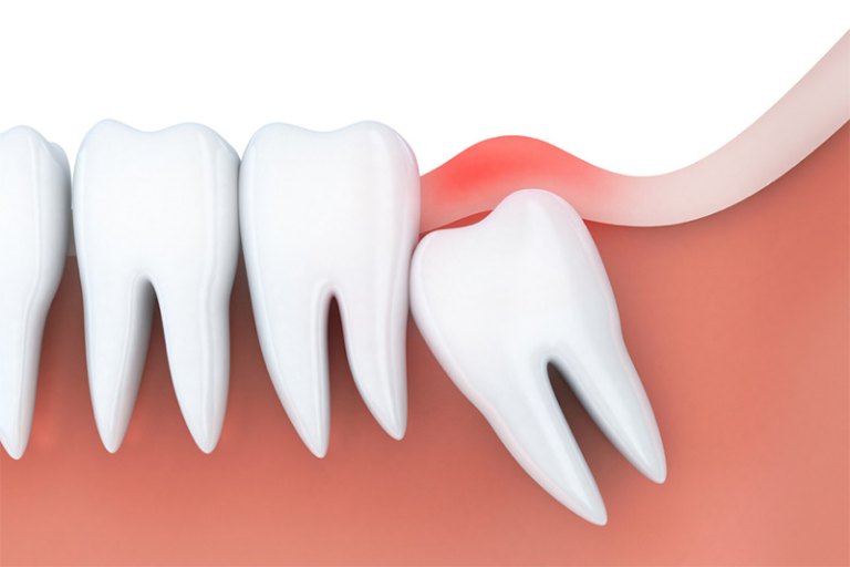 Răng khôn mọc lệch, mọc ngầm cũng có thể là nguyên nhân gây viêm lợi trùm có mủ