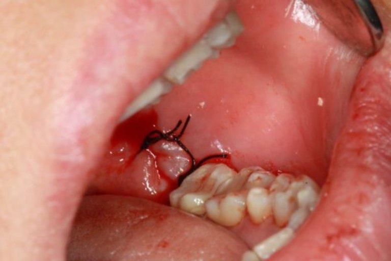 Cân nhắc nhổ răng khôn để điều trị dứt điểm viêm lợi trùm