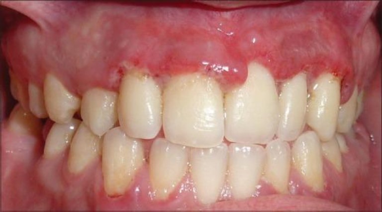 Viêm nướu hoại tử lở loét đặc trưng với các vết loét và hoại tử ở nướu răng