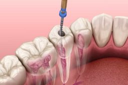 Chữa viêm tủy răng xong vẫn đau nhức có thể do nhiều nguyên nhân gây ra