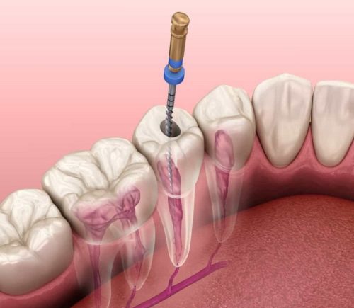 Chữa viêm tủy răng xong vẫn đau nhức có thể do nhiều nguyên nhân gây ra