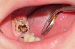 Viêm tủy răng số 6, số 7 xảy ra khi phần tủy của răng bị tổn thương, viêm nhiễm nghiêm trọng