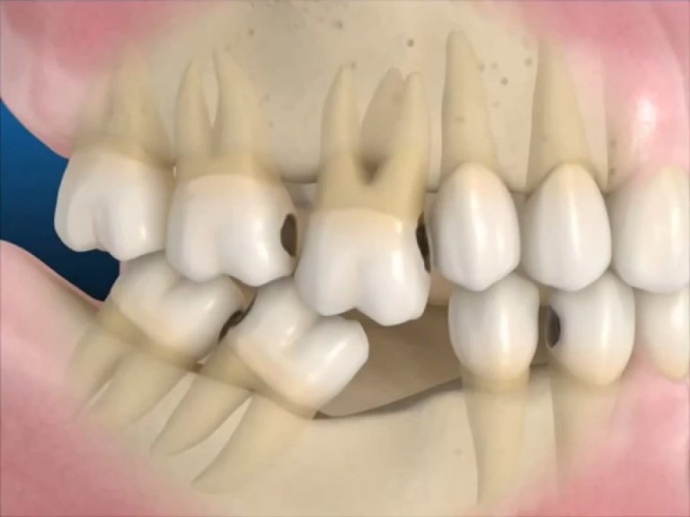 Mất răng là biến chứng nghiêm trọng của viêm tủy răng, ảnh hưởng đến các răng khác và cả khuôn mặt