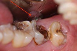 Răng chết tủy tồn tại được bao lâu là thắc mắc chung của nhiều người