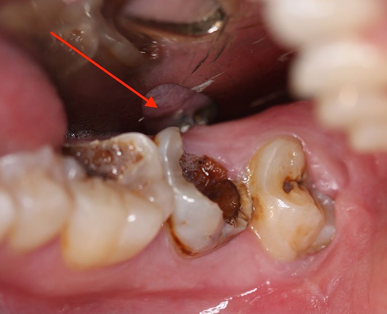 Răng chết tủy tồn tại được bao lâu là thắc mắc chung của nhiều người