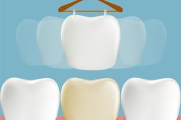 Ngả màu răng sau lấy tủy xảy ra rất phổ biến do nhiều nguyên nhân gây ra