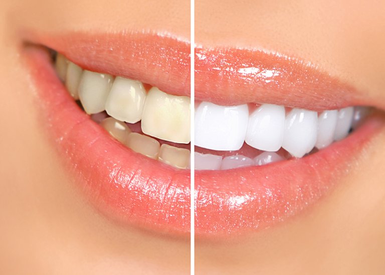 Răng đã điều trị tủy có thể tẩy trắng bằng cách đặt thuốc tẩy vào buồng tủy