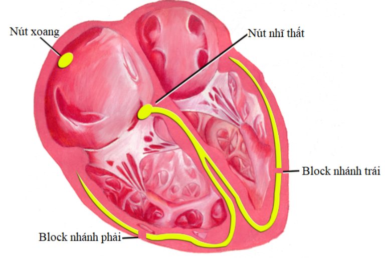 Nhồi máu cơ tim block nhánh phải thường liên quan đến thiểu năng vành gây thiếu máu cơ tim cục bộ