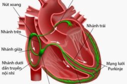 Nhồi máu cơ tim block nhánh phải là tình trạng không hiếm gặp