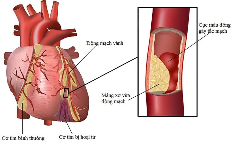 Nguyên nhân gây nhồi máu cơ tim cấp là do tắc nghẽn động mạch vành làm gián đoạn lưu thông máu đến tim