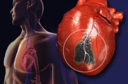 Người đã bị nhồi máu cơ tim sống được bao lâu là thắc mắc chung của nhiều người