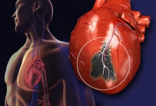 Người đã bị nhồi máu cơ tim sống được bao lâu là thắc mắc chung của nhiều người