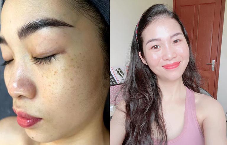 Làn da của chị Trang sau 1 liệu trình sử dụng Vương Phi