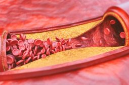 Xơ vữa động mạch là tình trạng thành động mạch dày lên và kém đàn hồi