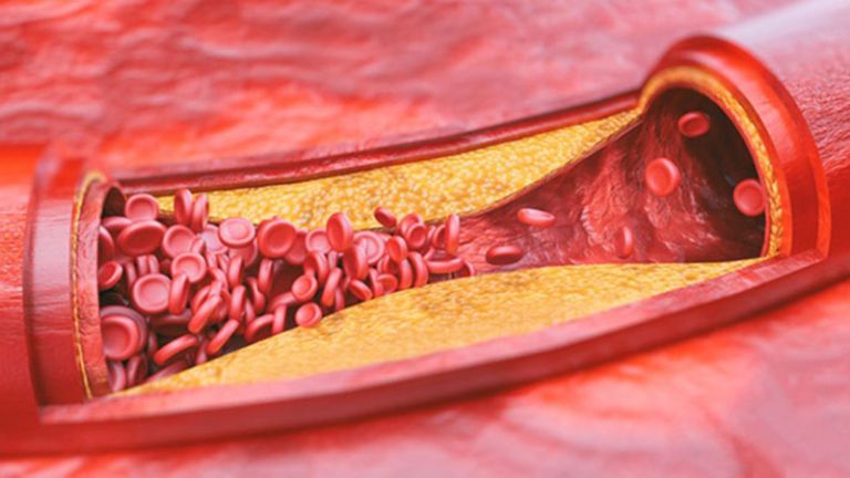 Xơ vữa động mạch là tình trạng thành động mạch dày lên và kém đàn hồi