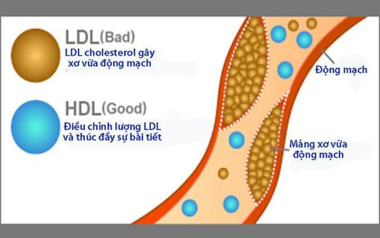 Căn bệnh này thường liên quan đến sự gia tăng cholesterol xấu và suy giảm lượng cholesterol tốt