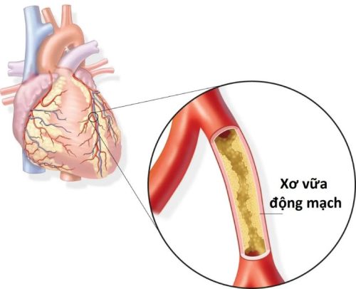 Xơ vữa động mạch vành là tình trạng tích tụ cholesterol, canxi, tế bào ở động mạch vành đảm nhận nhiệm vụ cung cấp máu nuôi tim