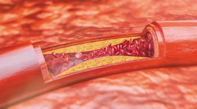 Có rất nhiều yếu tố thúc đẩy sự hình thành và phát triển của mảng xơ vữa động mạch