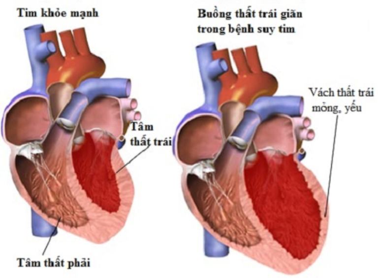 Suy tim là tình trạng cơ tim yếu đi khiến tim không thể thực hiện tốt chức năng bơm máu 
