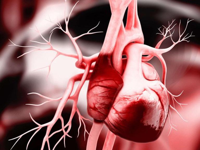 Bệnh tim thiếu máu cục bộ xảy ra khi lượng máu đến tim giảm sút khiến cơ tim không được cung cấp đủ máu, oxy và dưỡng chất cần thiết