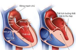 Cơ tim phì đại làm giảm thể tích của buồng thất trái, ảnh hưởng nghiêm trọng đến chức năng tim