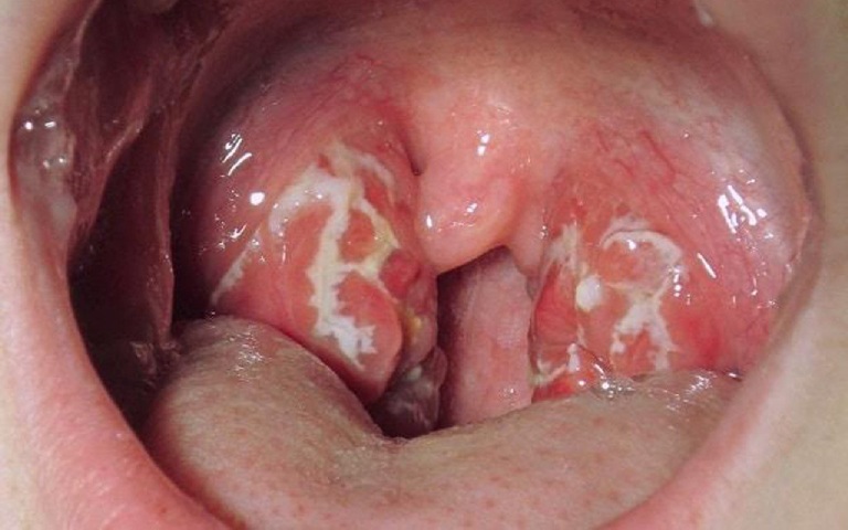 Bệnh viêm họng