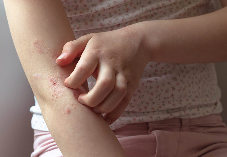 Eczema khiến da khô ráp, nổi mẩn đỏ và ngứa ngáy khó chịu