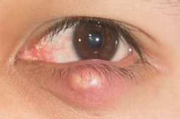 Lẹo mắt là khối u nổi lên ở mí mắt