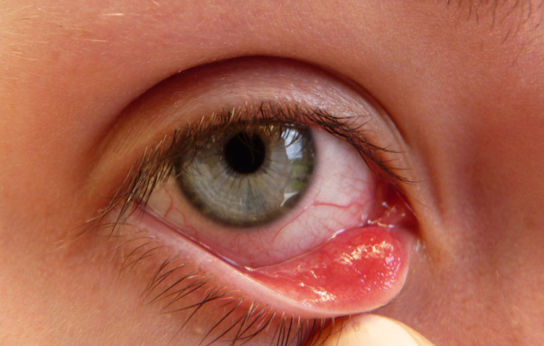 Lẹo mắt do nhiễm trùng tuyến dầu ở mí mắt 